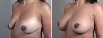 Mommy Makeover Patient 38