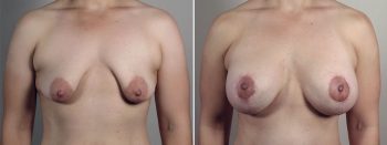 Mommy Makeover Patient 39