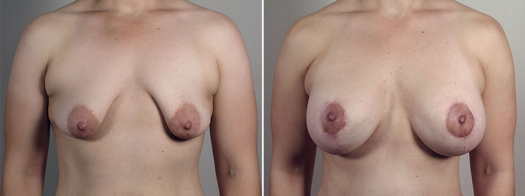 Mommy Makeover Patient 39