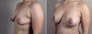 Mommy Makeover Patient 39