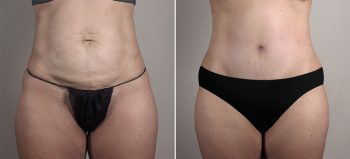 Mommy Makeover Patient 39