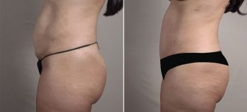 Mommy Makeover Patient 39