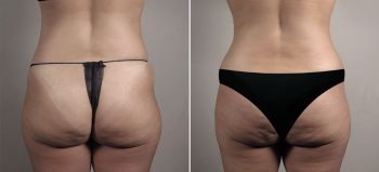 Mommy Makeover Patient 39