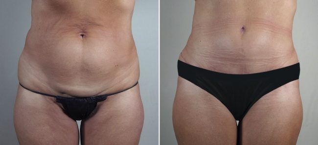 Before & After Tummy Tuck Without Tightening Muscles Before & After Tummy Tuck Without Tightening Muscles