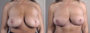 Mommy Makeover Patient 33