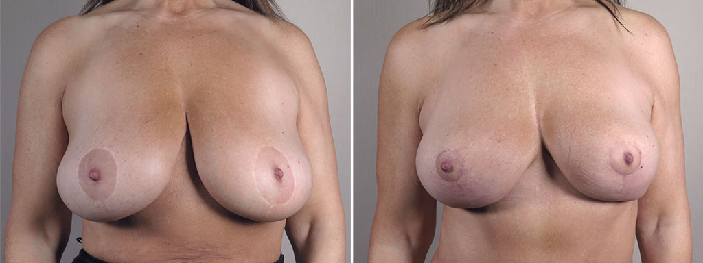 Mommy Makeover Patient 33