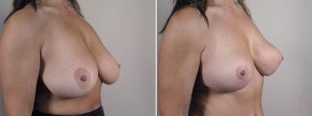 Mommy Makeover Patient 33