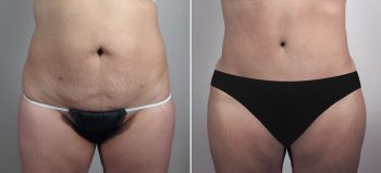 Mommy Makeover Patient 38