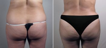 Mommy Makeover Patient 38