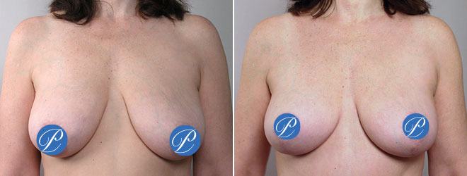 New Jersey Mommy Makeover