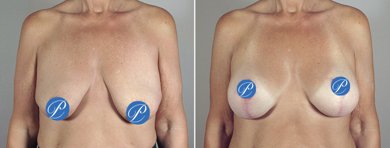New Jersey Breast Lift with Implants