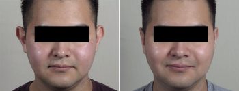 Otoplasty 21
