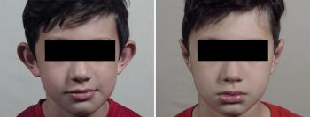 Otoplasty 22