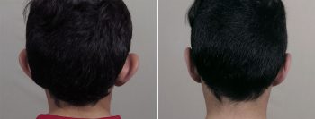 Otoplasty 22