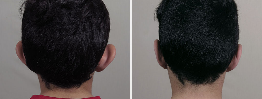 Otoplasty 22